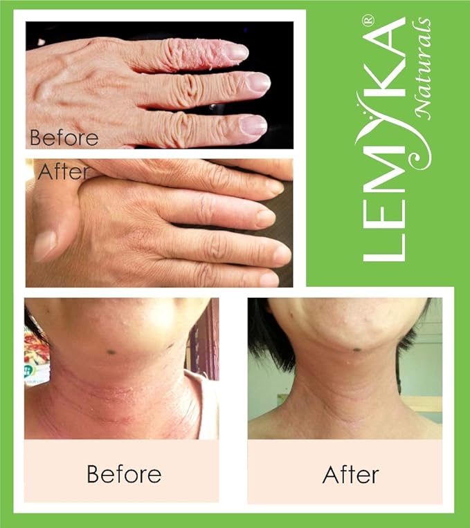 LEMYKA Eczema Flare Defense Natural Calming Cream - 3 Pack Bundle, for Infants, babies, kids, and adults with Eczema (Atopic Dermatitis), Dry Itchy Patches, Skin Rashes, Steroid Free