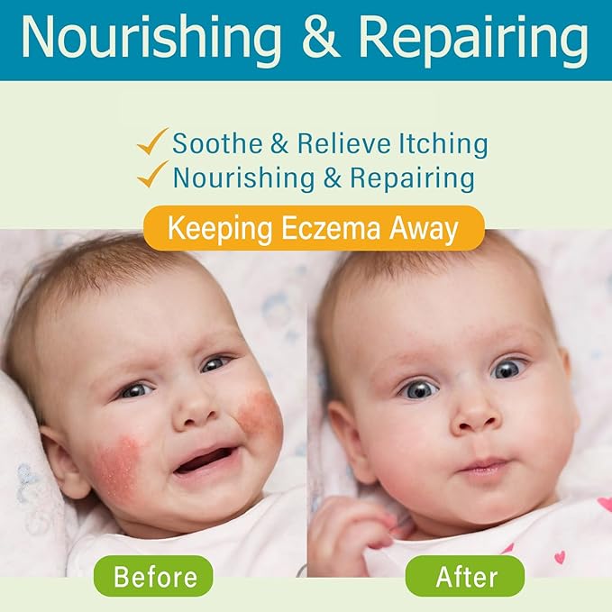 Baby Eczema Cream - Kids Eczema Therapy & Relief Body Cream, Nourishing Skin Protectant Soothes & Relieves Dry, Hypoallergenic, Fragrance & Steroid-Free (100ml, Fl Oz, 3.38) (White+)