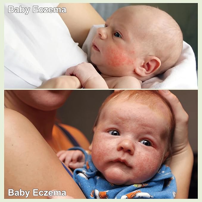 Heat Rash Care Cream for Babies | Prevents Prickly Heat, Sweat Rashes, Eczema & Skin Inflammation | Alleviating Discomfort for Babies Skin | 100ml/3.38oz (100ml/1pack)