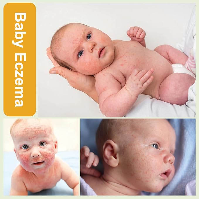 Baby Eczema Cream - Kids Eczema Therapy & Relief Body Cream, Nourishing Skin Protectant Soothes & Relieves Dry, Hypoallergenic, Fragrance & Steroid-Free (100ml, Fl Oz, 3.38) (White+)