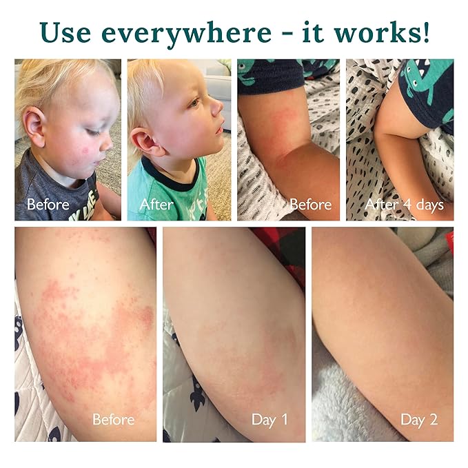 Baby and Kids Moisturizing Cream for Sensitive Skin Multi Purpose for Eczema Psoriasis Rosacea Dermatitis Rash, Healing Therapy for Dry Cracked Irritated Itchy Skin